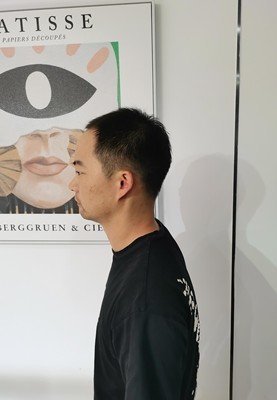 补发前侧面效果 补发前侧面效果