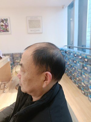 补发前侧面效果