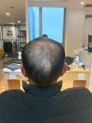 补发前背面效果