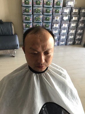 补发前头发稀疏秃顶 补发前头发稀疏秃顶