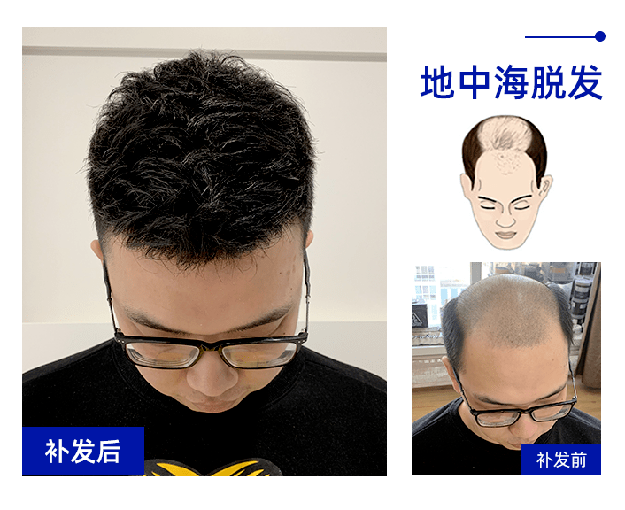 地中海脱发佩戴假发效果 地中海脱发佩戴假发效果