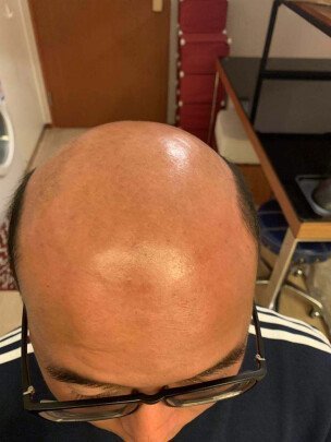 掉发严重秃顶 掉发严重秃顶