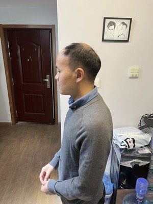 补发前秃顶效果:侧面 补发前秃顶效果:侧面