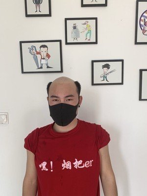 发际线高、秃顶怎么办