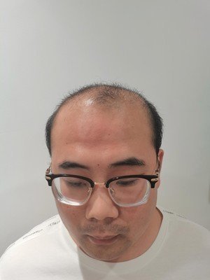 补发前头发稀疏、秃顶