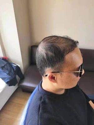 补发前侧面效果：头发稀疏