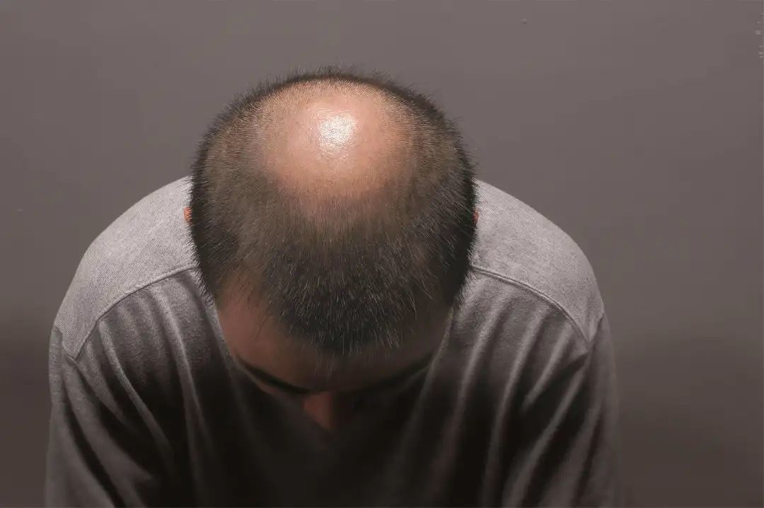 什么是脂溢性脱发？如何预防脂溢性脱发
