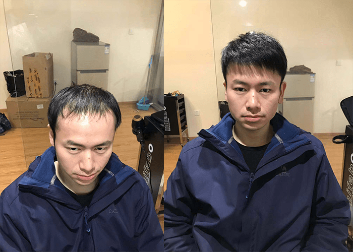 男孩子发际线高怎么改善？