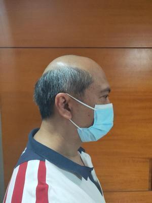 补发前秃顶 补发前秃顶