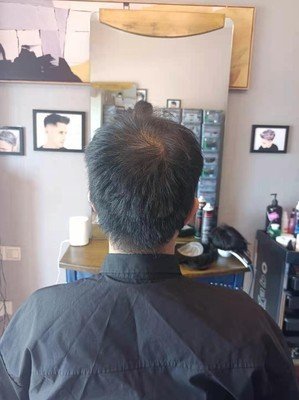 补发前头顶头发稀疏:背面 补发前头顶头发稀疏:背面