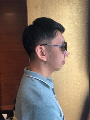 补发后侧面效果