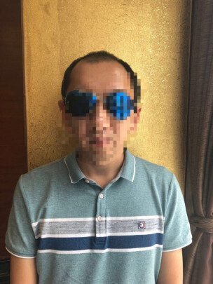 补发前正面效果：M型脱发