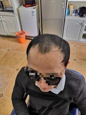 补发前M型脱发正面效果 补发前M型脱发正面效果