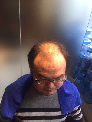 补发前头顶头发稀疏 补发前头顶头发稀疏
