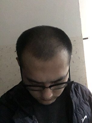 补发前头发稀疏,M型脱发 补发前头发稀疏,M型脱发