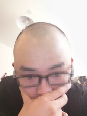 补发前秃头效果 补发前秃头效果