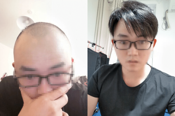 男生戴假发需要把头发剃光吗？