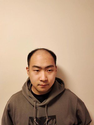补发前发际线高接近秃顶 补发前发际线高接近秃顶