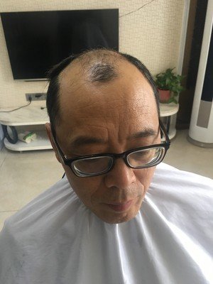 补发前头顶头发稀疏 补发前头顶头发稀疏