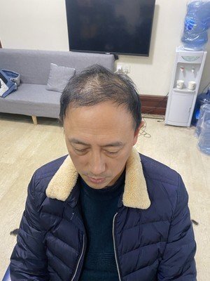假发补发前效果 假发补发前效果