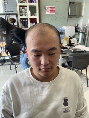 补发前头发稀少 补发前头发稀少