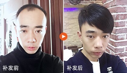 脱发怎么治疗ZUI好？
