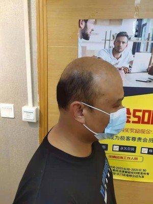 补发前秃顶