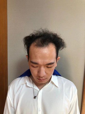 补发前M型脱发