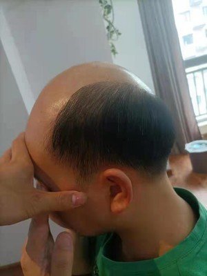 补发前秃顶 补发前秃顶