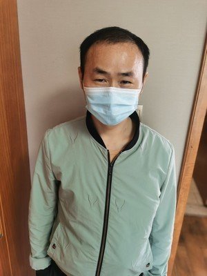 补发前发际线高