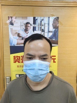 补发前额头高 补发前额头高