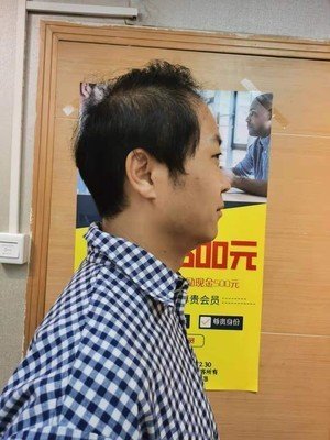 补发前头发稀疏 补发前头发稀疏