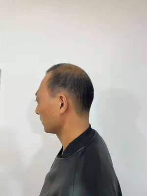 补发前头发太稀少 补发前头发太稀少