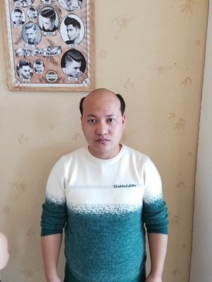 补发前秃顶 补发前秃顶