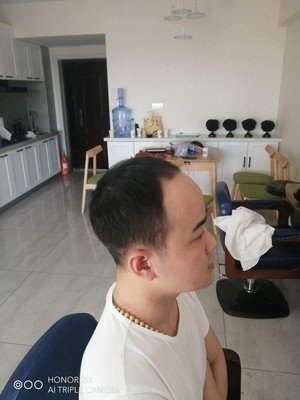 补发前额头超高