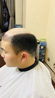 补发前秃顶效果
