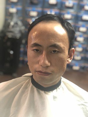 补发前额头高