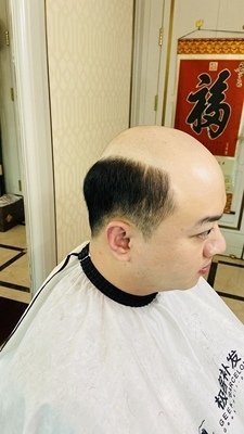 补发前秃顶