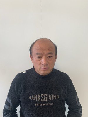 补发前秃顶老气