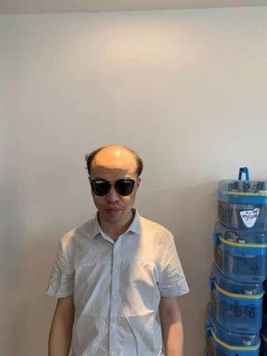 补发前光亮秃顶 补发前光亮秃顶