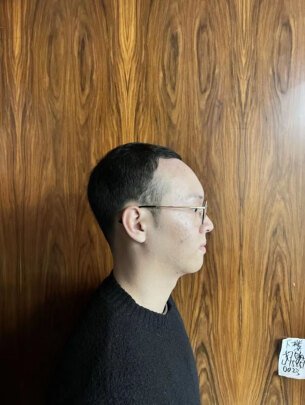 补发前额头高