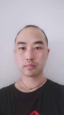 补发前头发稀少接近秃顶