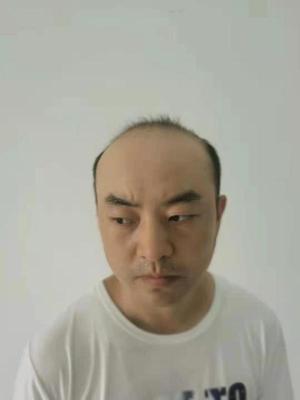 秃顶补发前