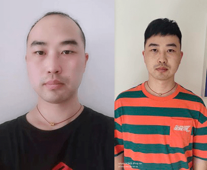 假发补发片可靠么？