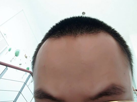掉发严重呈M型发 掉发严重呈M型发