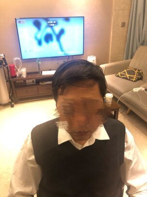 补发前接受秃顶 补发前接受秃顶