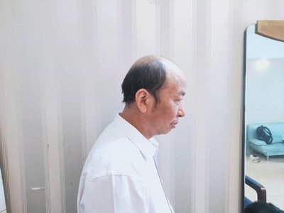 补发前秃顶