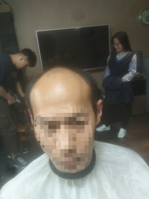 补发前经典秃顶 补发前经典秃顶