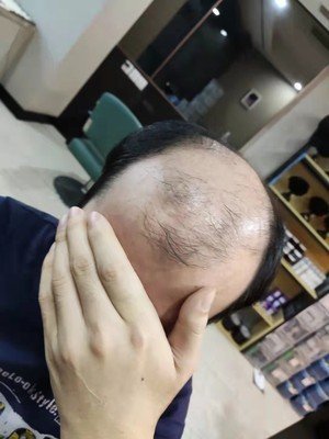 秃顶补发前效果 秃顶补发前效果