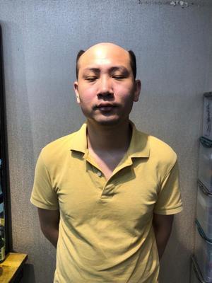 补发前秃顶 补发前秃顶